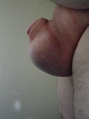 Felt amazing after getting this bulge out of my tube, took a good 5 minutes to get it out.