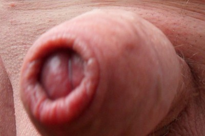 Foreskin closed from the front.