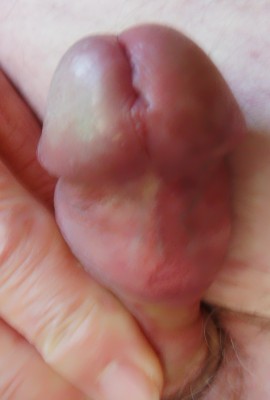 Penis with frenulektomy