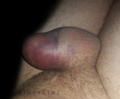 07-24hour-bruising.jpg