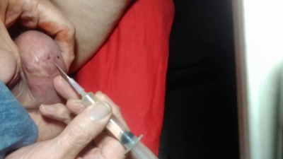 Starting through skin.